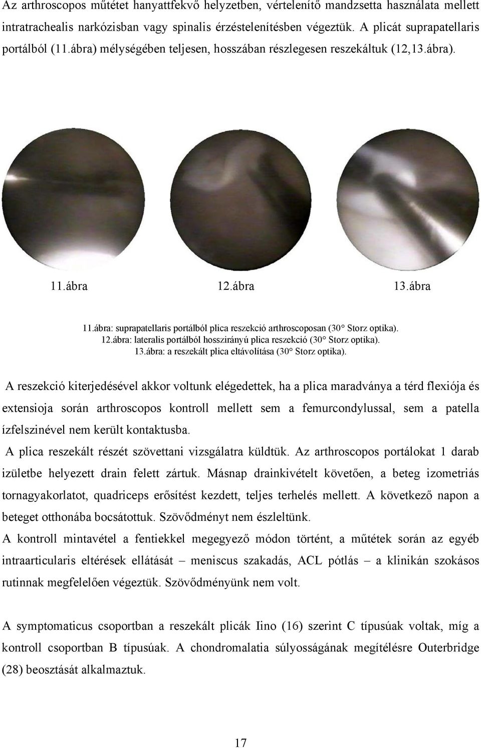 13.ábra: a reszekált plica eltávolítása (30 Storz optika).