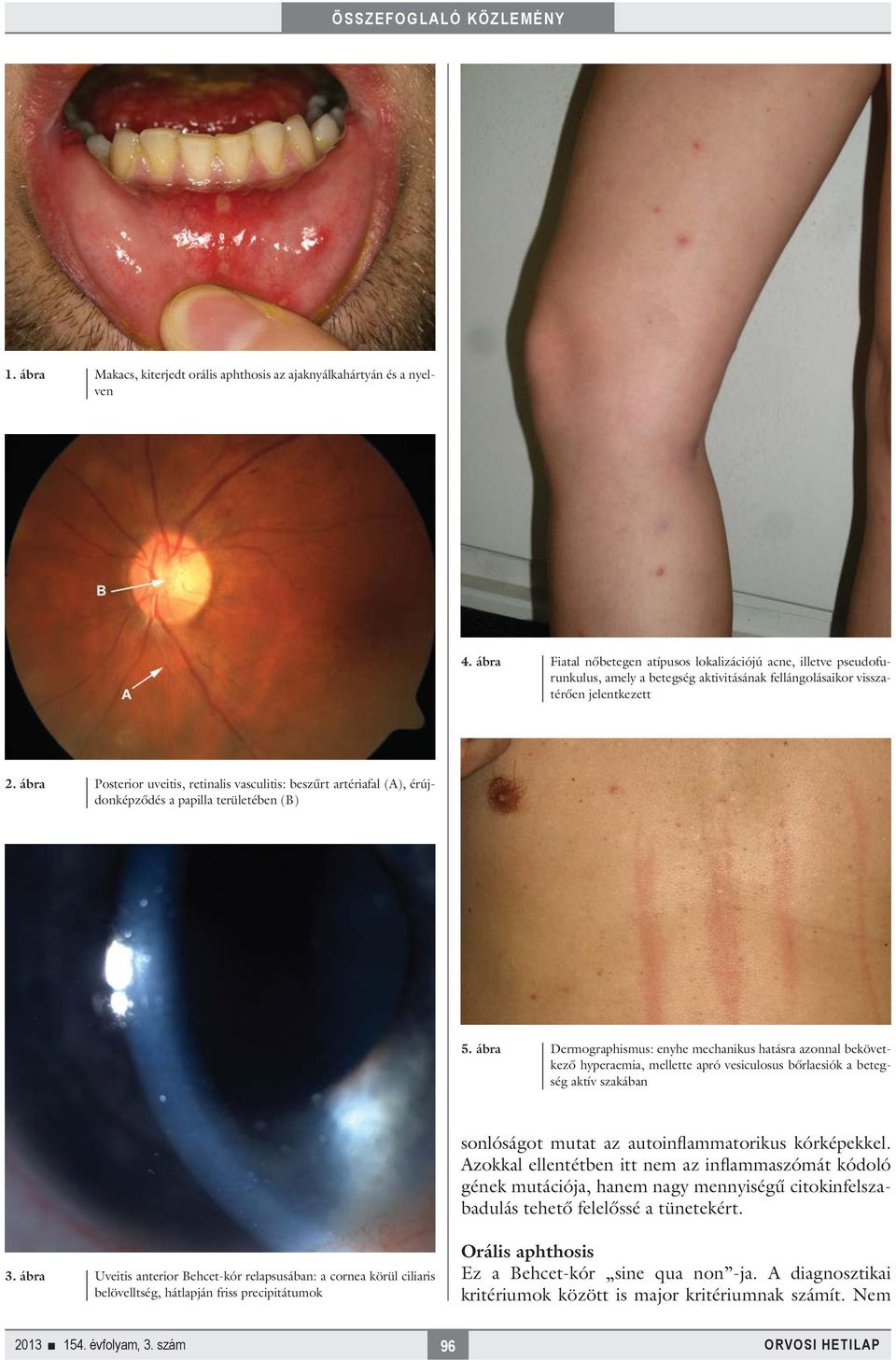 ábra Posterior uveitis, retinalis vasculitis: beszűrt artériafal (A), érújdonképződés a papilla területében (B) 5.
