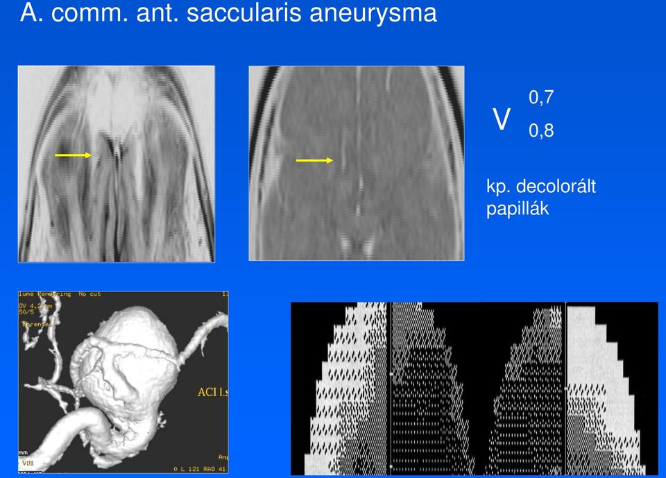 aneurysma V 0,7