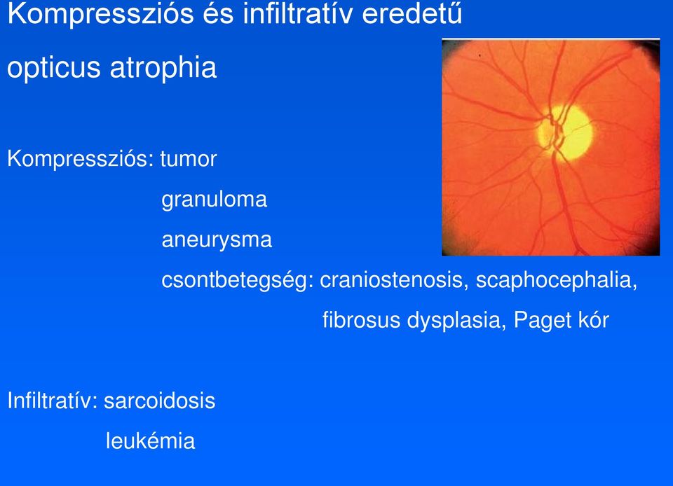 csontbetegség: craniostenosis, scaphocephalia,