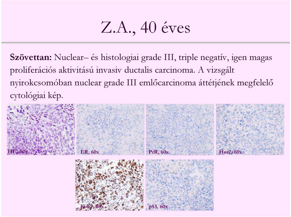 A vizsgált nyirokcsomóban nuclear grade III emlőcarcinoma áttétjének