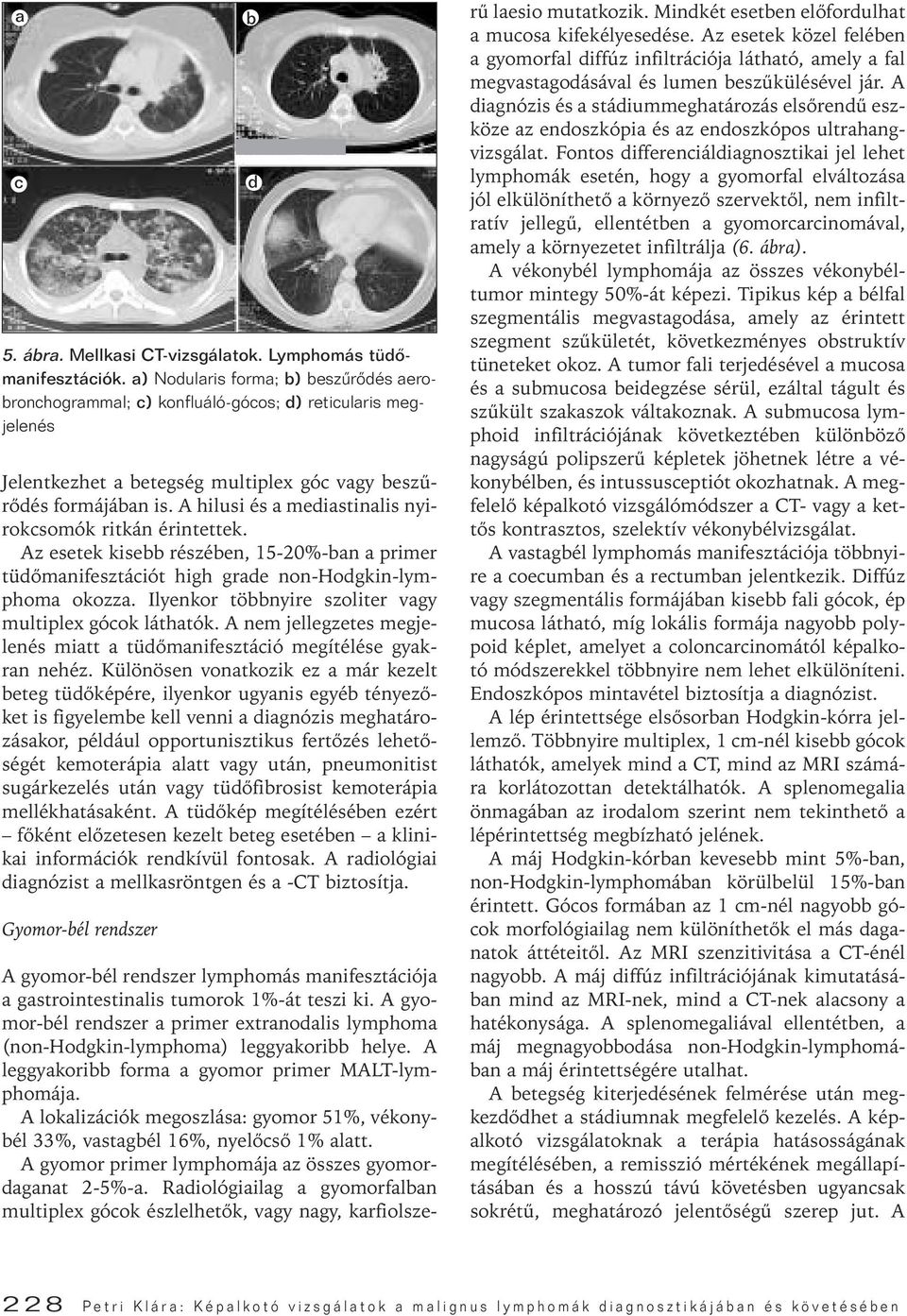 A hilusi és a mediastinalis nyirokcsomók ritkán érintettek. Az esetek kisebb részében, 15-20%-ban a primer tüdômanifesztációt high grade non-hodgkin-lymphoma okozza.