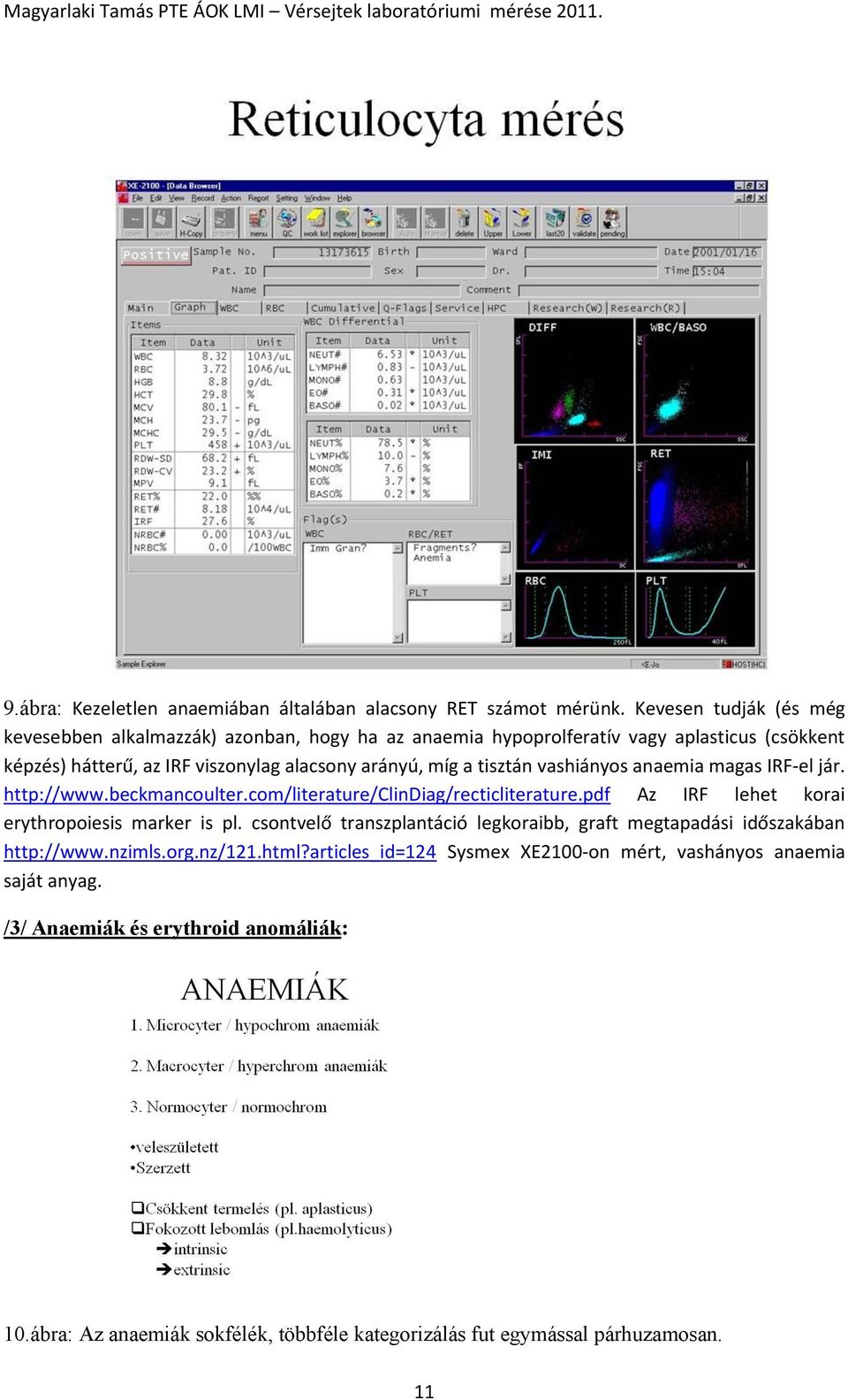 tisztán vashiányos anaemia magas IRF-el jár. http://www.beckmancoulter.com/literature/clindiag/recticliterature.pdf Az IRF lehet korai erythropoiesis marker is pl.