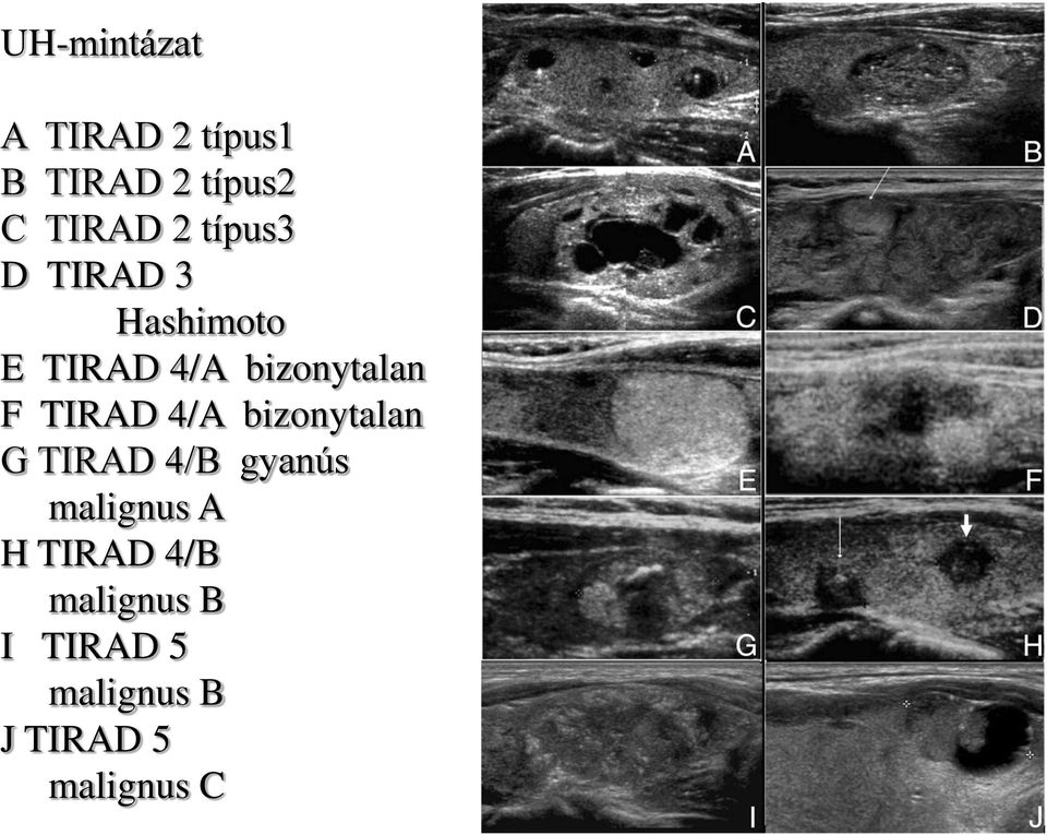 TIRAD 4/A bizonytalan G TIRAD 4/B gyanús malignus A H