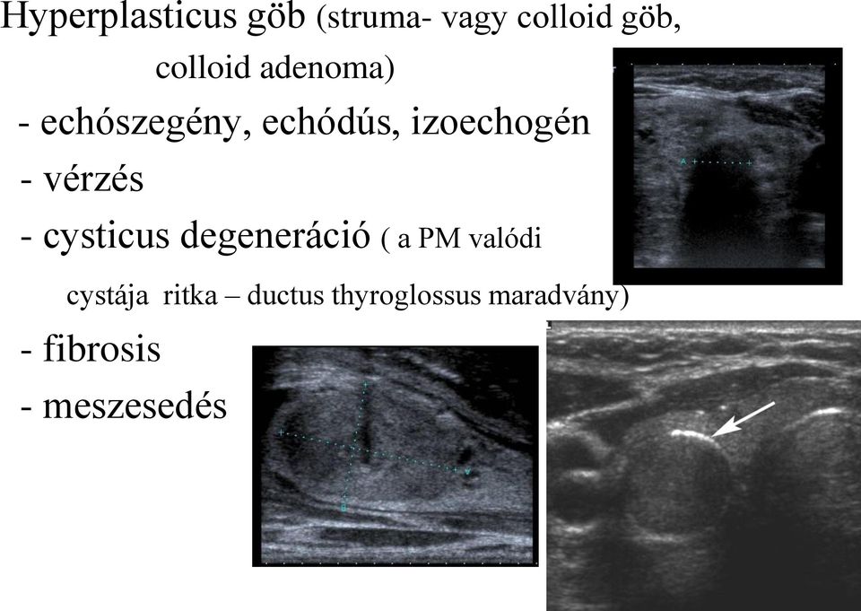 - vérzés - cysticus degeneráció ( a PM valódi