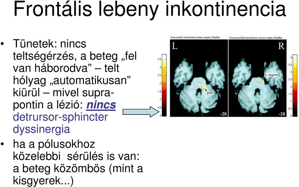 supra- pontin a lézió: nincs detrursor-sphincter dyssinergia ha a