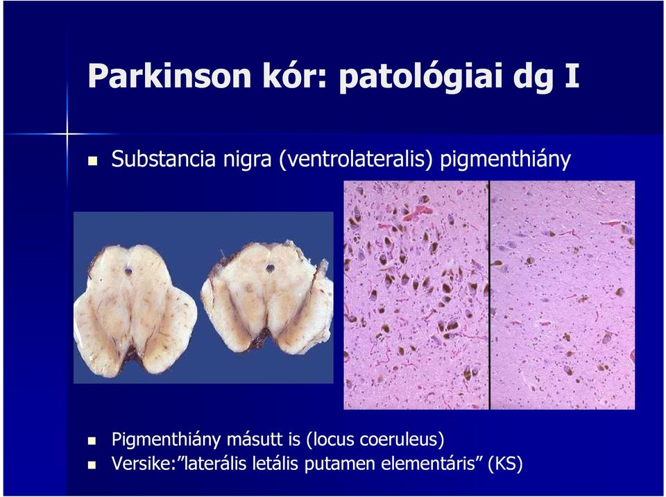 Pigmenthiány másutt is (locus coeruleus)