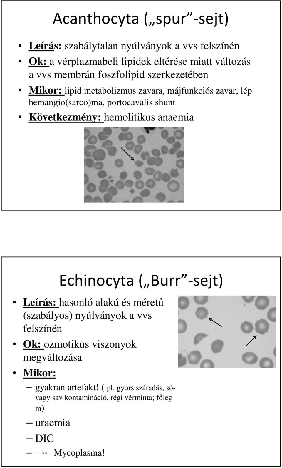 Következmény: hemolitikus anaemia Echinocyta ( Burr -sejt) Leírás: hasonló alakú és méretű (szabályos) nyúlványok a vvs felszínén Ok: