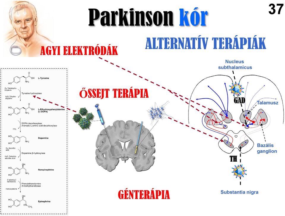 subthalamicus ŐSSEJT TERÁPIA GAD