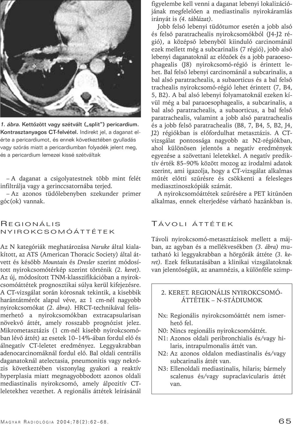 csigolyatestnek több mint felét infiltrálja vagy a gerinccsatornába terjed. Az azonos tüdôlebenyben szekunder primer góc(ok) vannak.