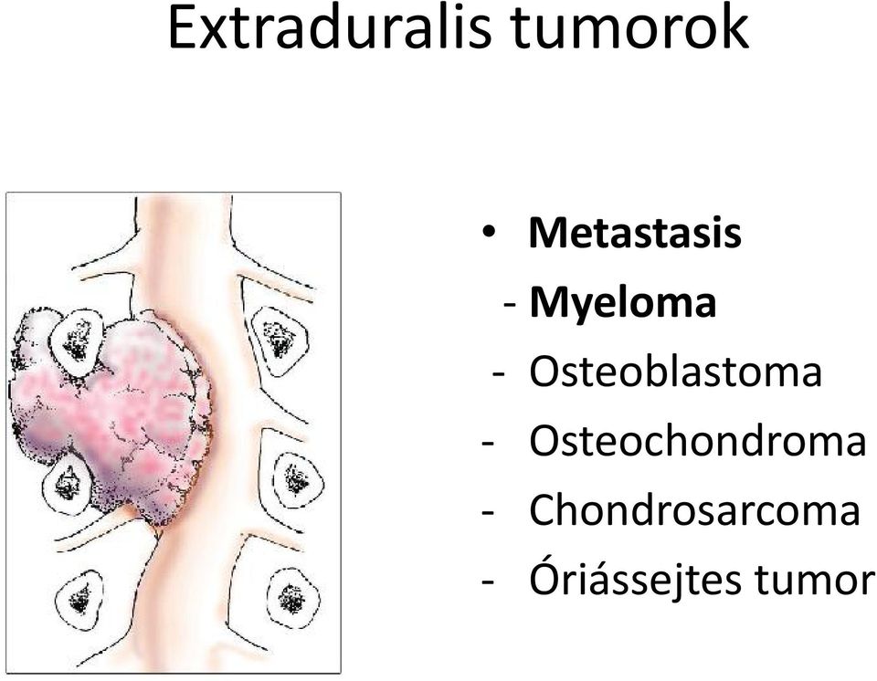 Osteoblastoma