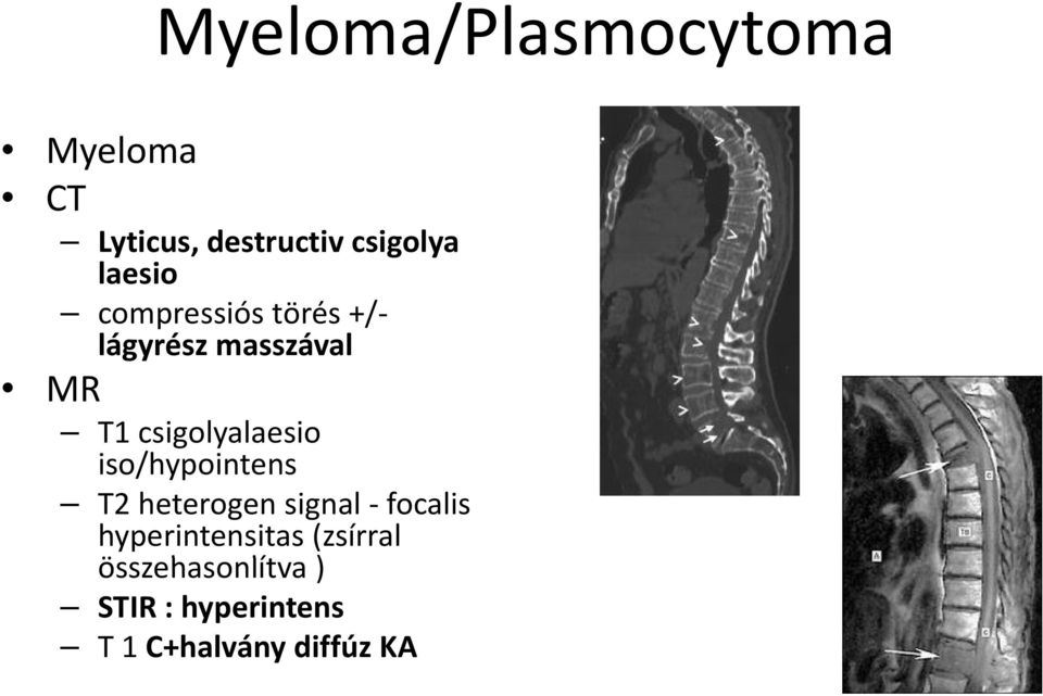 csigolyalaesio iso/hypointens T2 heterogen signal focalis