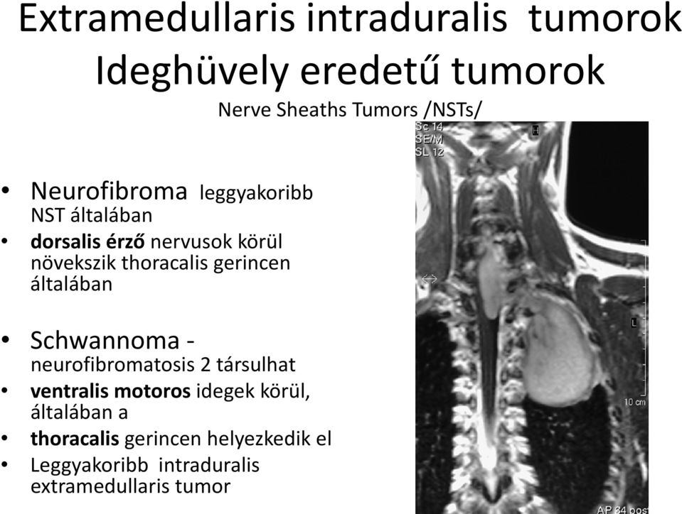 gerincen általában Schwannoma neurofibromatosis 2 társulhat ventralis motoros idegek körül,