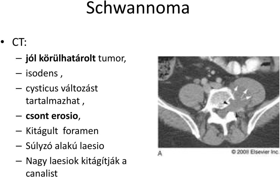 csont erosio, Kitágult foramen Súlyzó