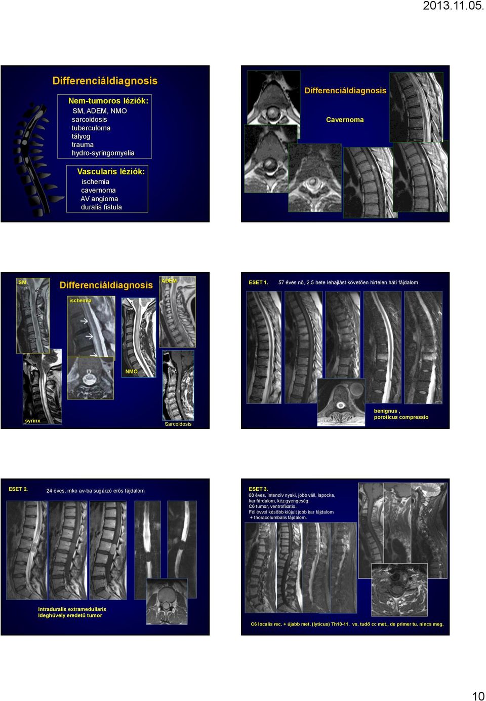 5 hete lehajlást követően hirtelen háti fájdalom ischemia NMO syrinx Sarcoidosis benignus, poroticus compressio ESET 2. 24 éves, mko av-ba sugárzó erős fájdalom ESET 3.