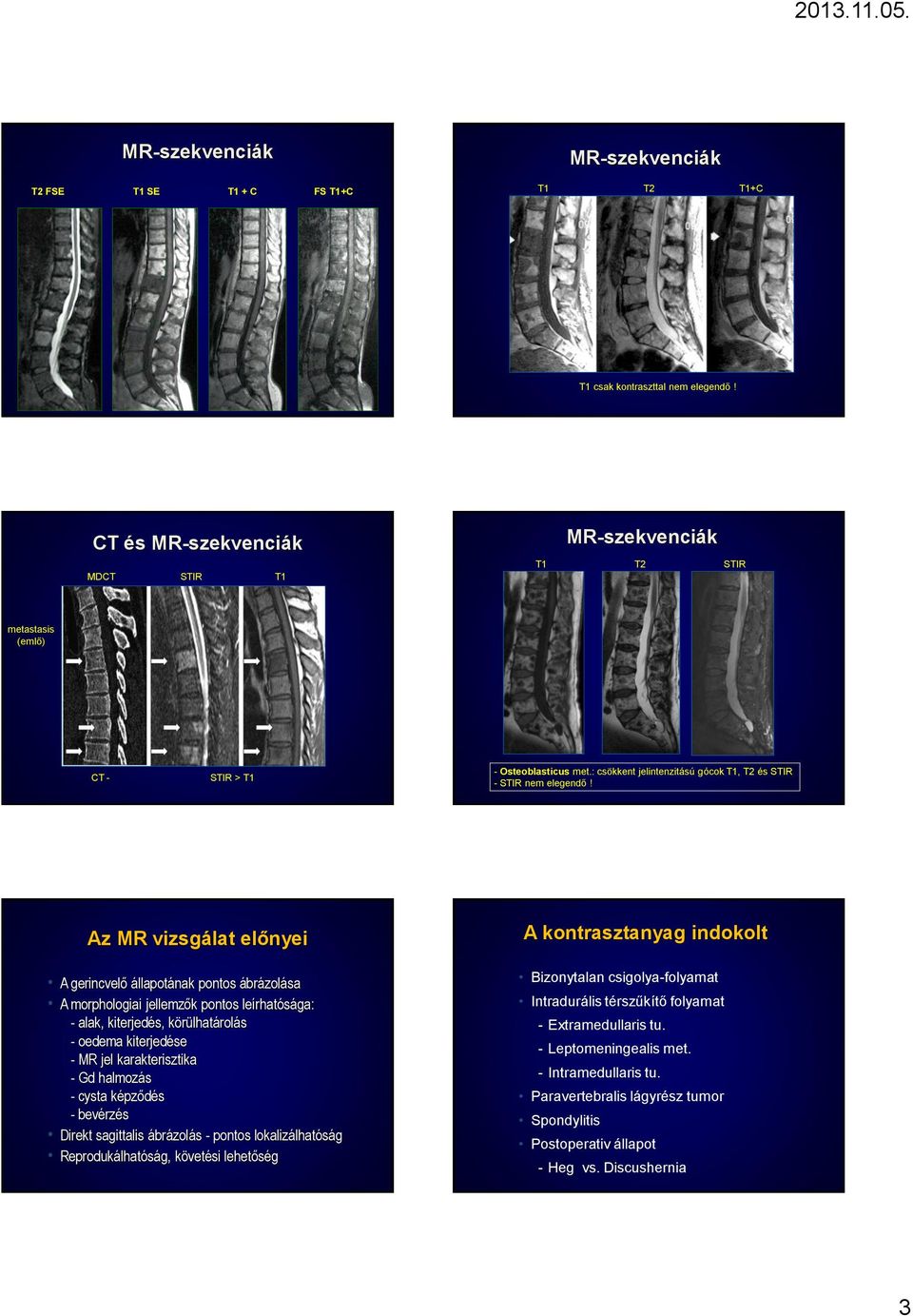 Az MR vizsgálat előnyei A gerincvelő állapotának pontos ábrázolása A morphologiai jellemzők pontos leírhatósága: - alak, kiterjedés, körülhatárolás - oedema kiterjedése - MR jel karakterisztika - Gd