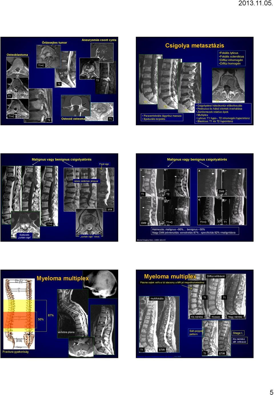 Malignus vagy benignus csigolyatörés Fluid sign Malignus vagy benignus csigolyatörés sávos oedemas jelzavar DWI STIR +C DWI +C +C Epiduralis curtain sign curtain sign nincs Biomed Imaging Interv J