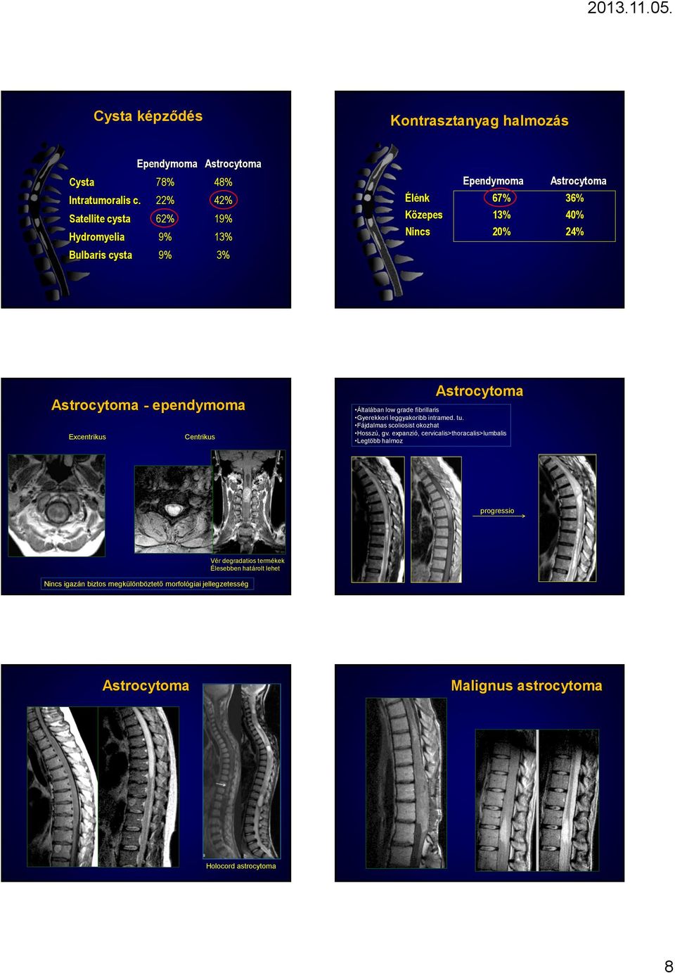 ependymoma Excentrikus Centrikus Astrocytoma Általában low grade fibrillaris Gyerekkori leggyakoribb intramed. tu. Fájdalmas scoliosist okozhat Hosszú, gv.