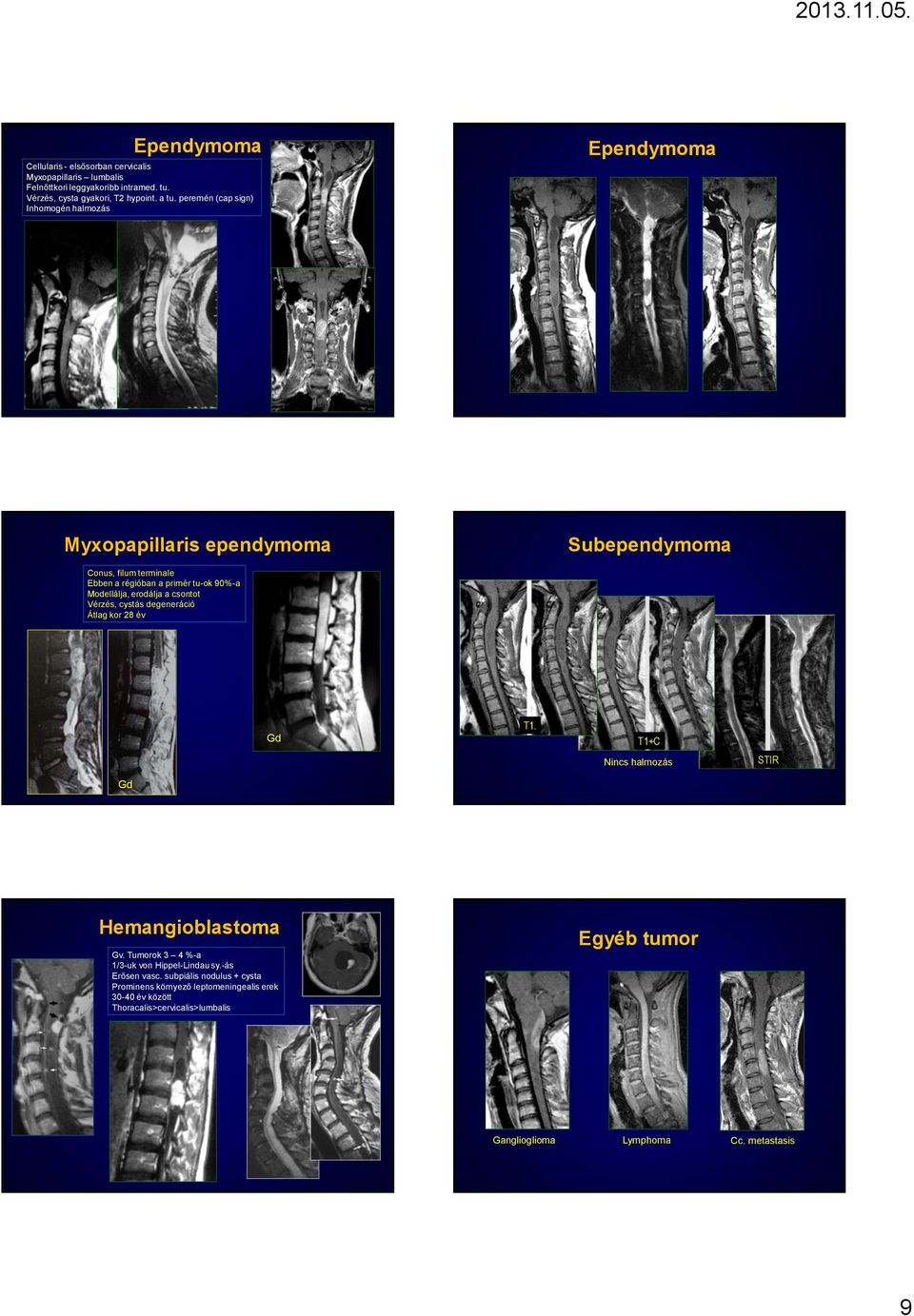 csontot Vérzés, cystás degeneráció Átlag kor 28 év Subependymoma Gd. +C Nincs halmozás STIR Gd Hemangioblastoma Gv. Tumorok 3 4 %-a 1/3-uk von Hippel-Lindau sy.