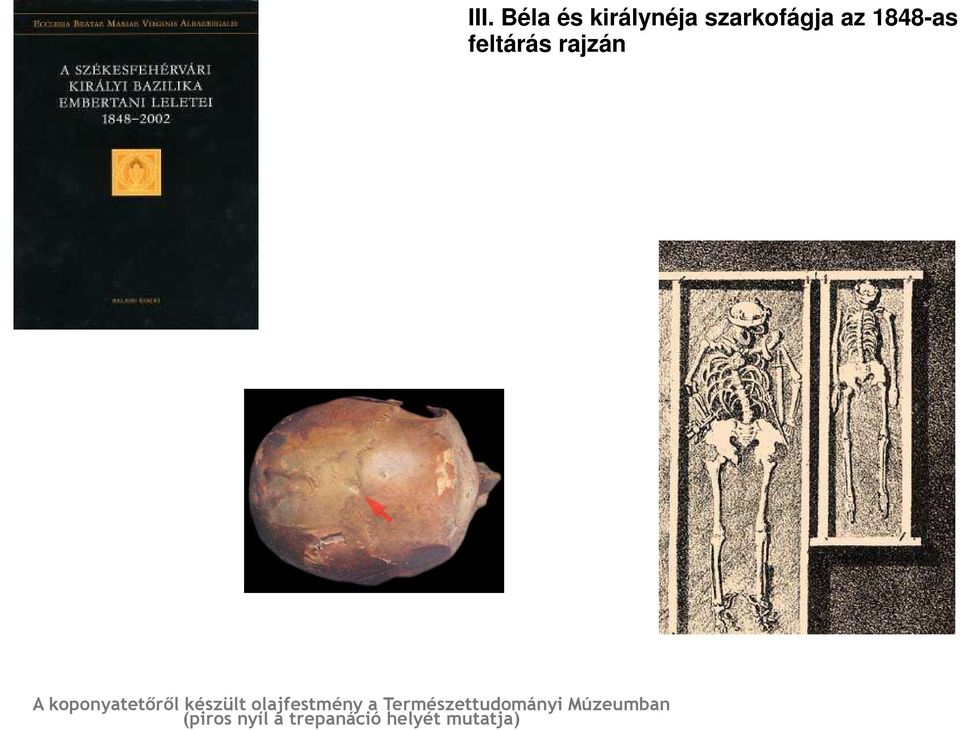 trepanáció helyét mutatja) III.