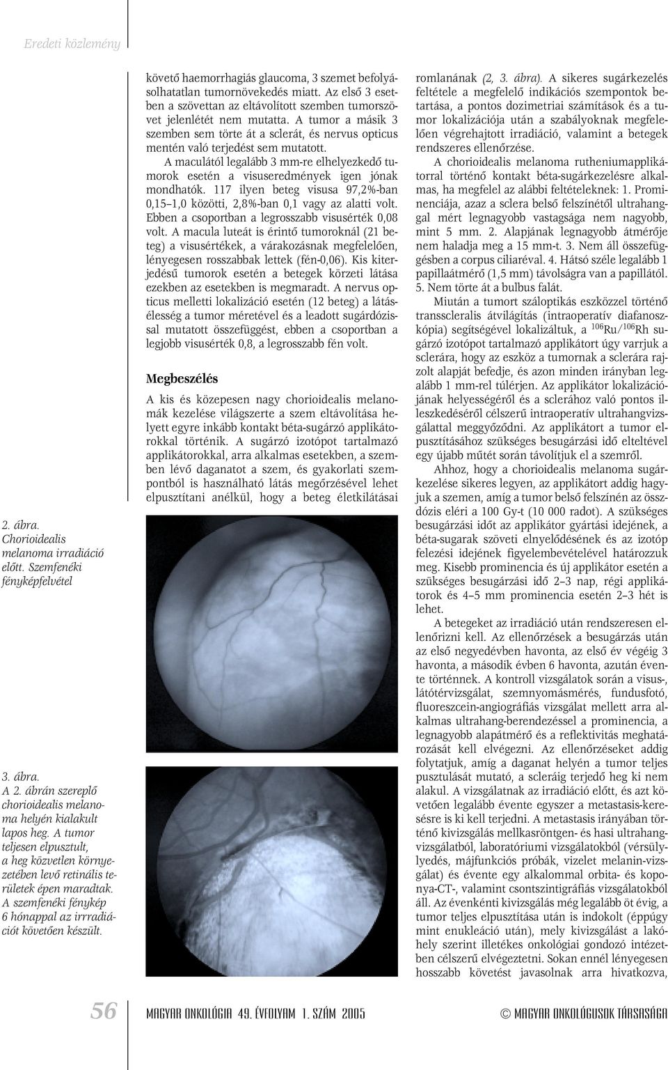 követô haemorrhagiás glaucoma, 3 szemet befolyásolhatatlan tumornövekedés miatt. Az elsô 3 esetben a szövettan az eltávolított szemben tumorszövet jelenlétét nem mutatta.