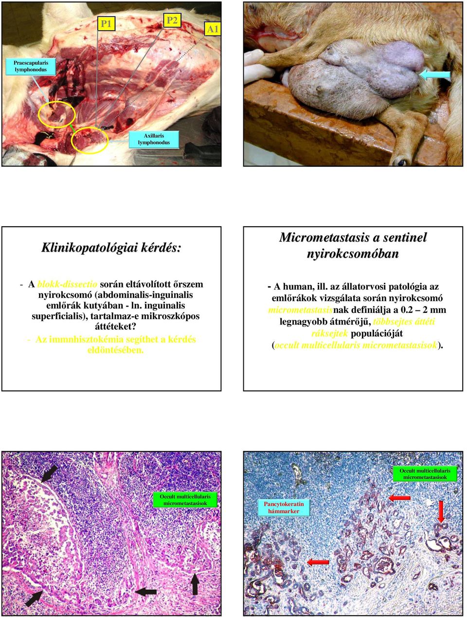 Micrometastasis a sentinel nyirokcsomóban - A human, ill. az állatorvosi patológia az emlırákok vizsgálata során nyirokcsomó micrometastasisnak definiálja a 0.