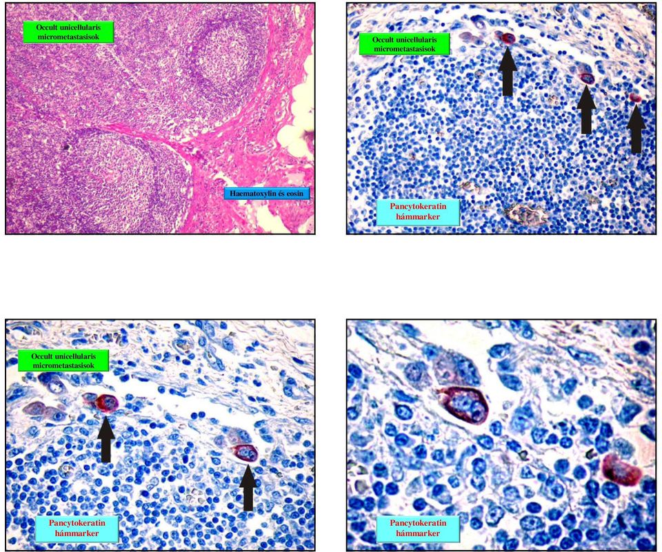 Pancytokeratin hámmarker Occult unicellularis