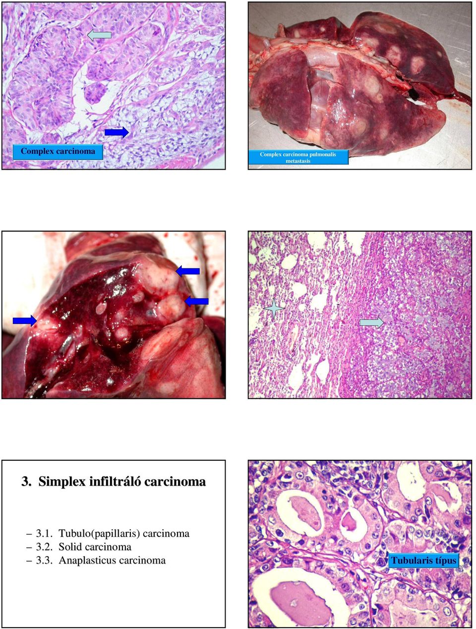 Tubulo(papillaris papillaris) carcinoma 3.2.