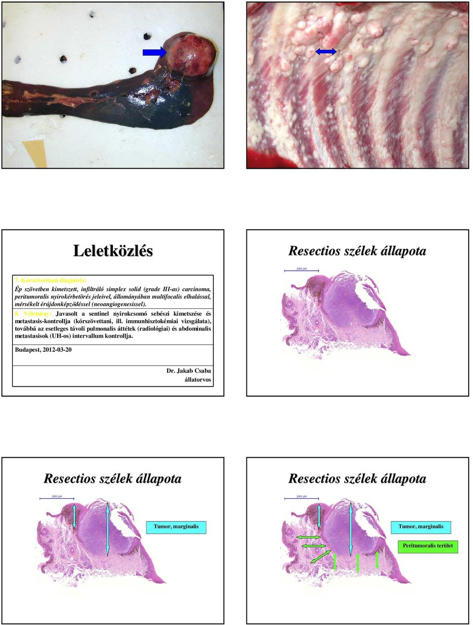 elhalással, mérsékelt érújdonképzıdéssel (neoangiogenesissel). 8. Vélemény: Javasolt a sentinel nyirokcsomó sebészi kimetszése és metastasis-kontrollja (kórszövettani, ill.