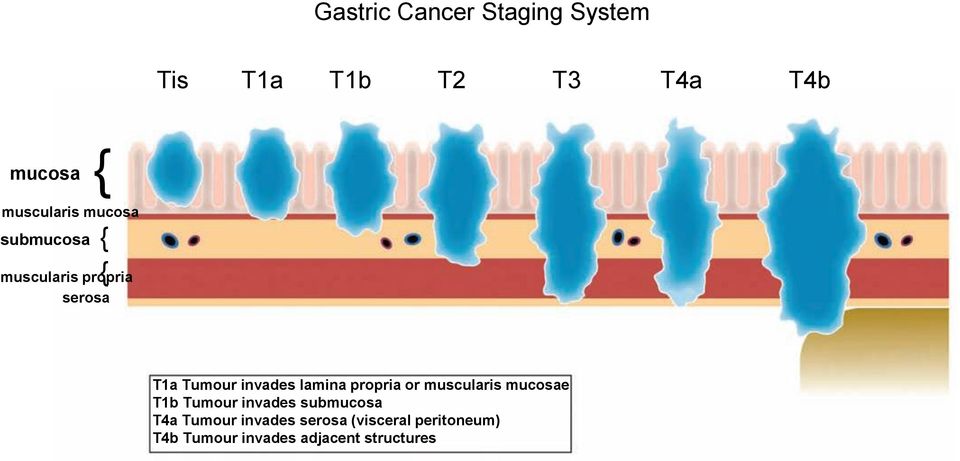 lamina propria or muscularis mucosae T1b Tumour invades submucosa T4a