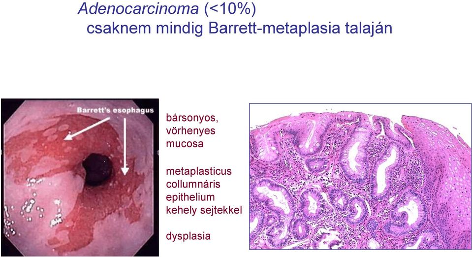 vörhenyes mucosa metaplasticus