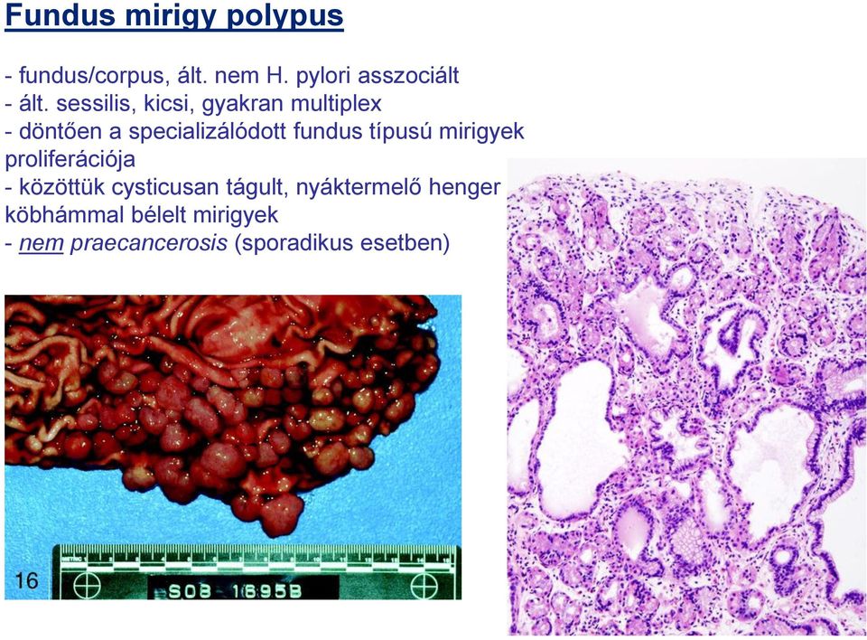 típusú mirigyek proliferációja - közöttük cysticusan tágult, nyáktermelő