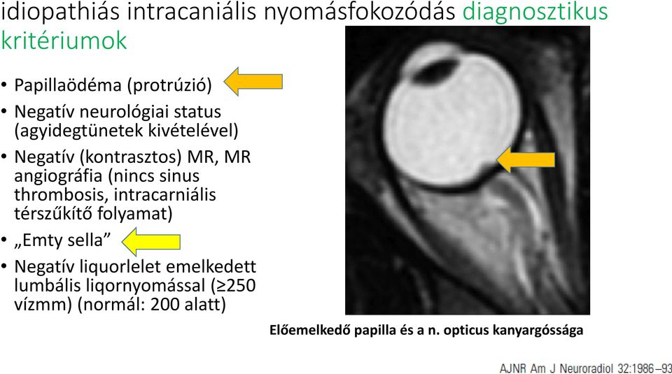 (nincs sinus thrombosis, intracarniális térszűkítő folyamat) Emty sella Negatív liquorlelet