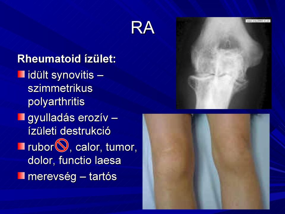 erozív ízületi destrukció rubor, calor,