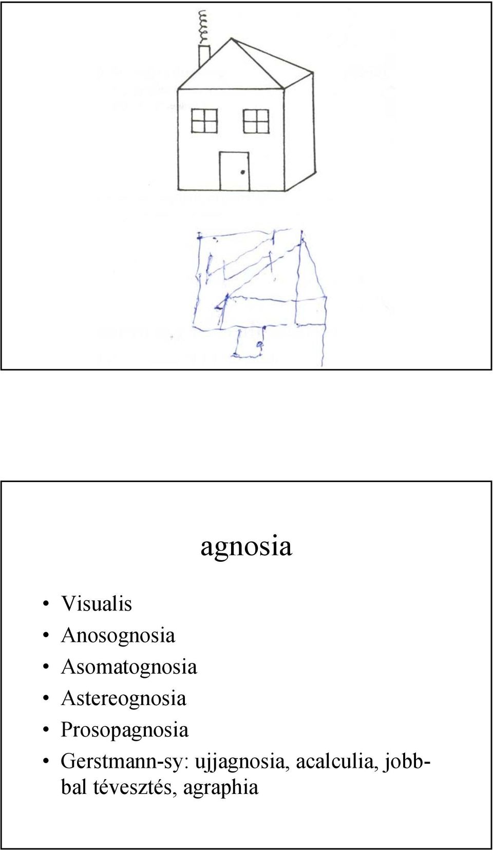 Prosopagnosia Gerstmann-sy: