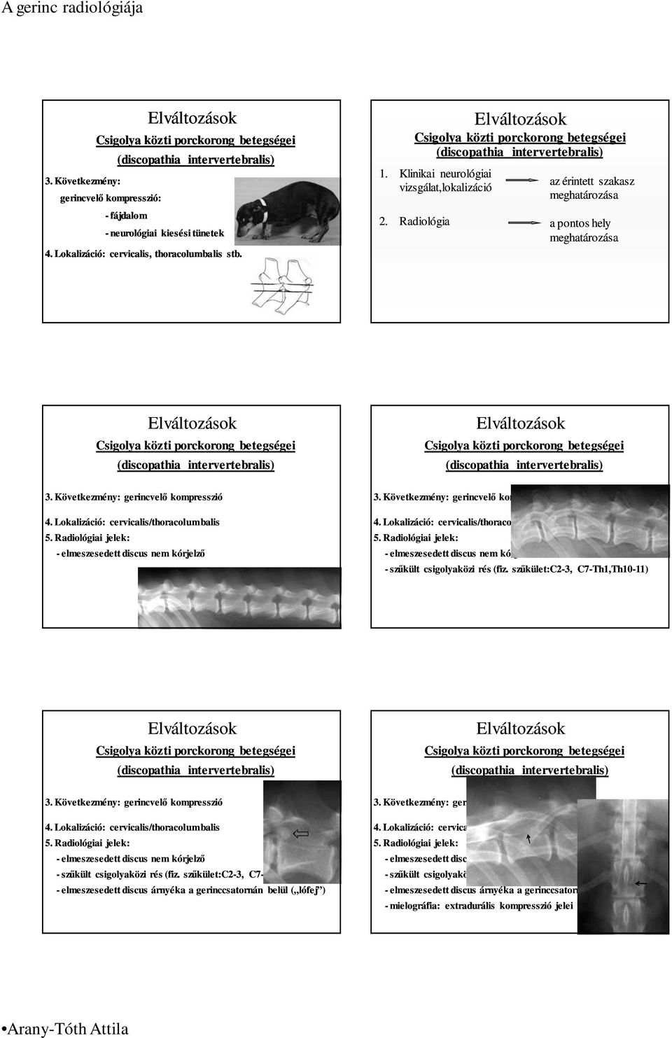 Radiológiai jelek: - elmeszesedett discus nem kórjelzı 3. Következmény: gerincvelı kompresszió 4. Lokalizáció: cervicalis/thoracolumbalis 5.