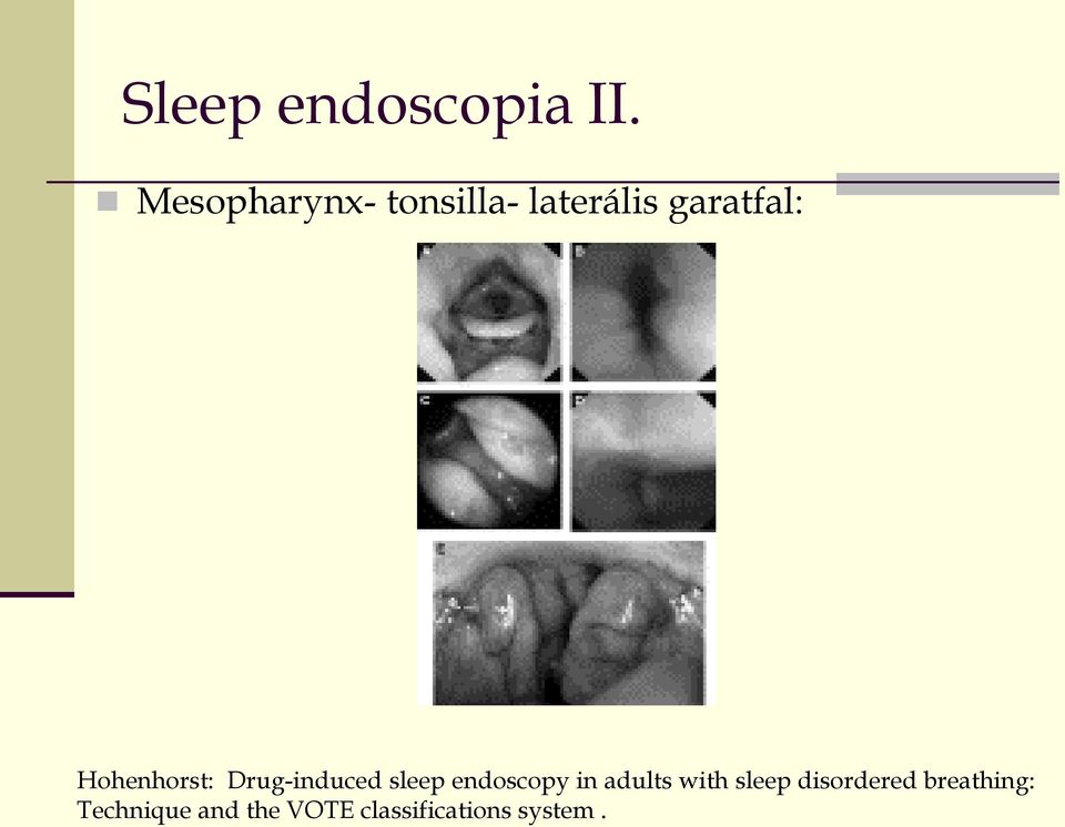 Hohenhorst: Drug-induced sleep endoscopy in