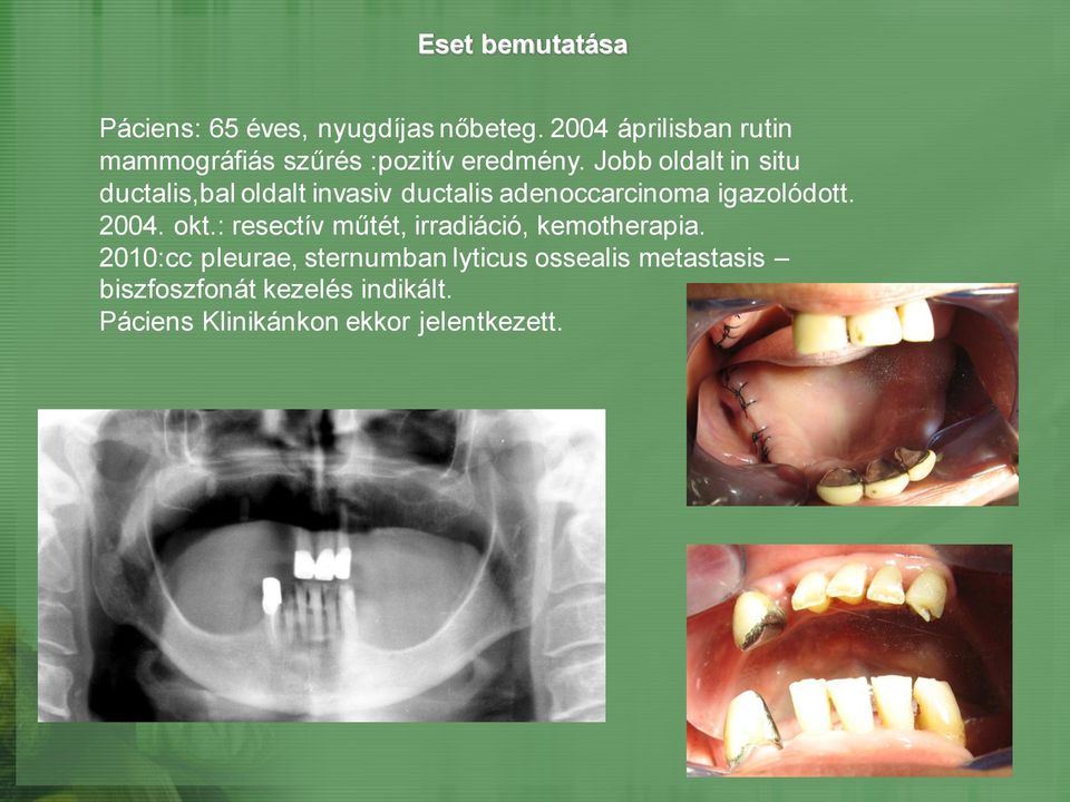 Jobb oldalt in situ ductalis,bal oldalt invasiv ductalis adenoccarcinoma igazolódott. 2004. okt.