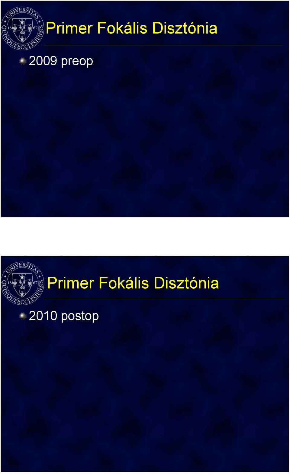 preop  Disztónia