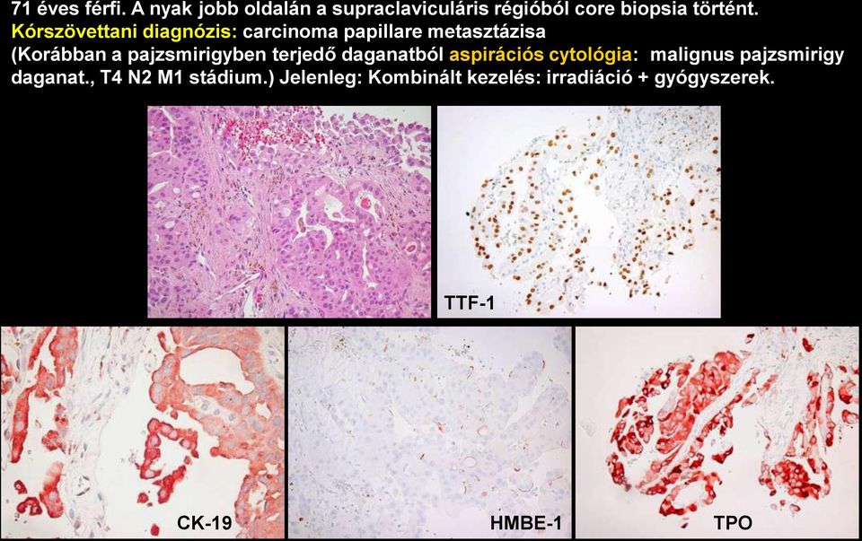 Kórszövettani diagnózis: carcinoma papillare metasztázisa (Korábban a pajzsmirigyben