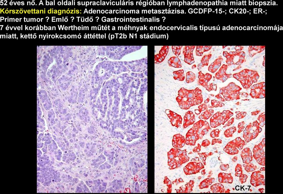 Kórszövettani diagnózis: Adenocarcinoma metasztázisa. GCDFP-15-; CK20-; ER-; Primer tumor?