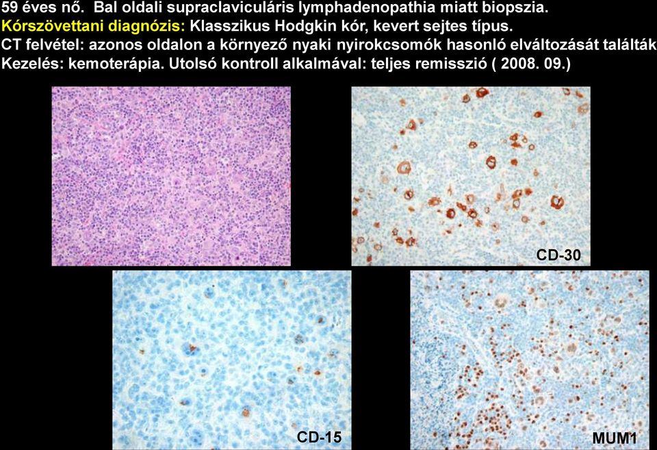 CT felvétel: azonos oldalon a környező nyaki nyirokcsomók hasonló elváltozását