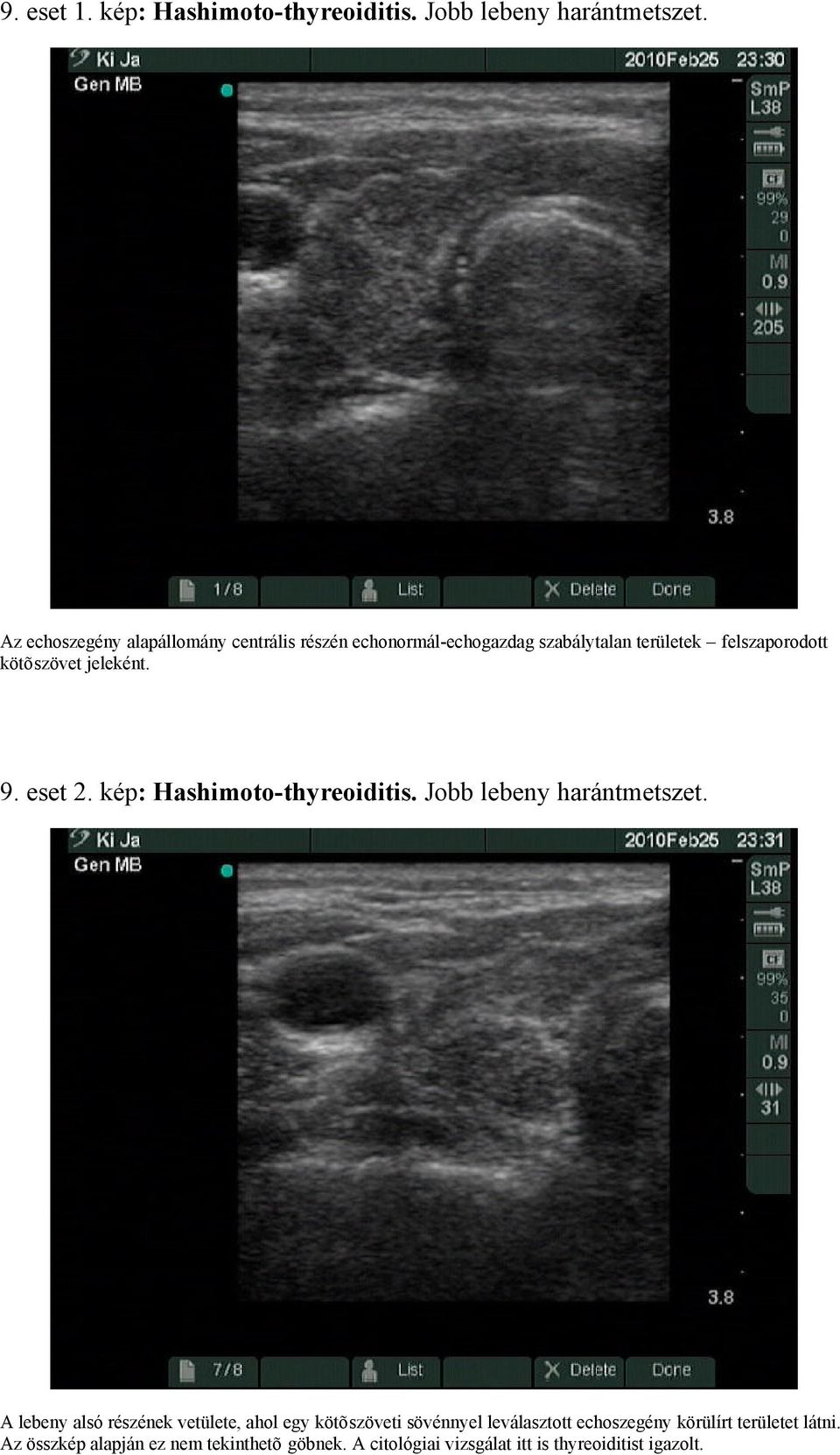 jeleként. 9. eset 2. kép: Hashimoto-thyreoiditis. Jobb lebeny harántmetszet.