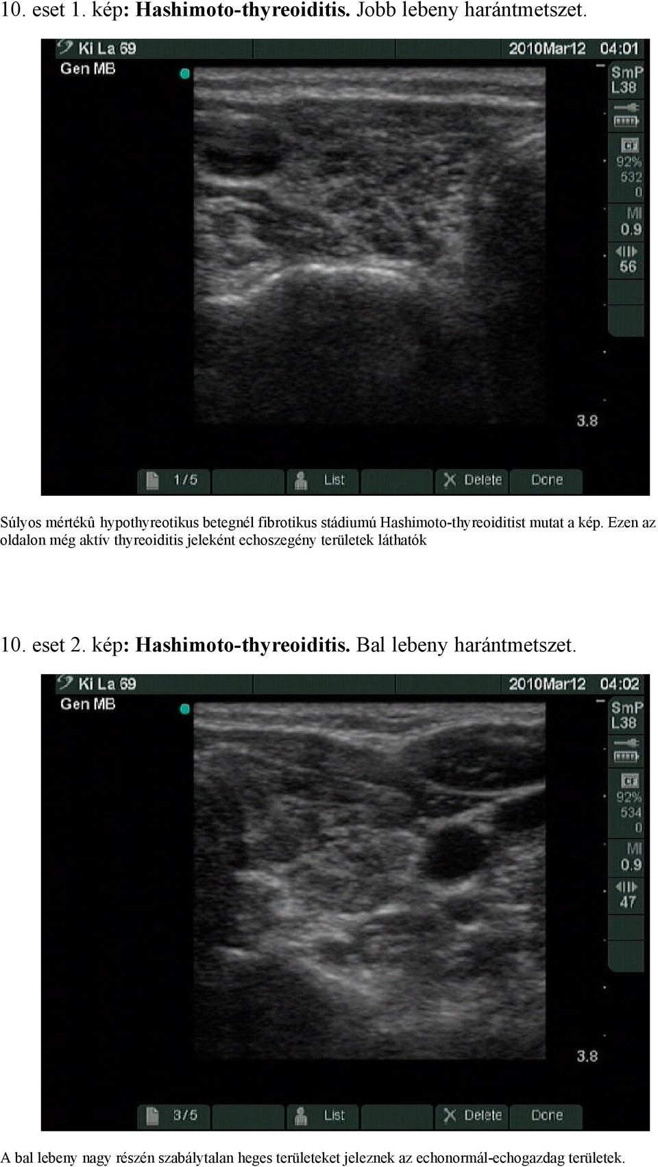 Ezen az oldalon még aktív thyreoiditis jeleként echoszegény területek láthatók 10. eset 2.