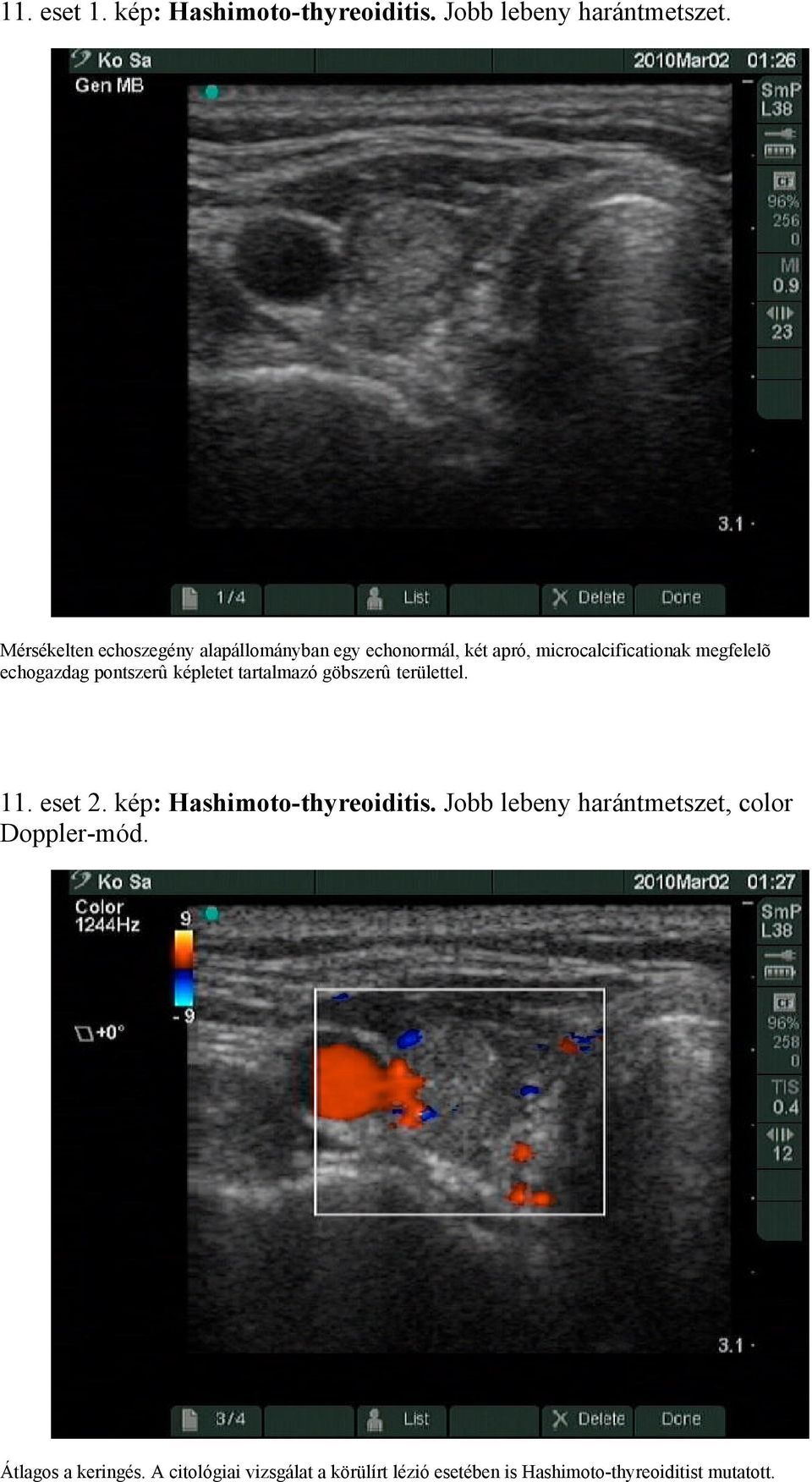 echogazdag pontszerû képletet tartalmazó göbszerû területtel. 11. eset 2. kép: Hashimoto-thyreoiditis.