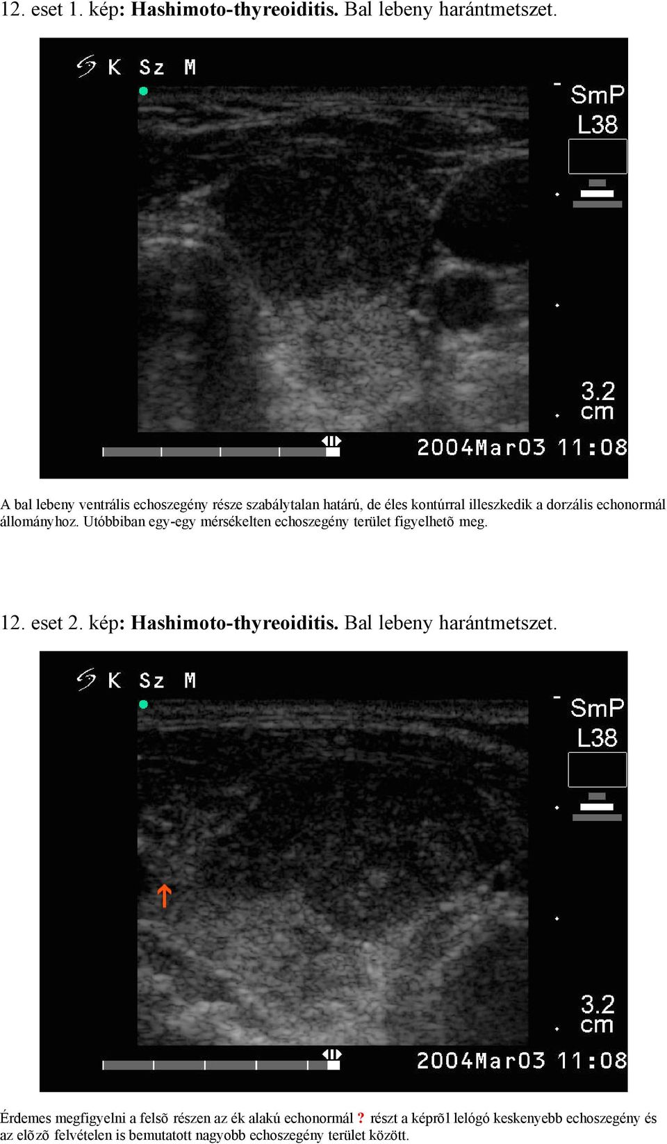 Utóbbiban egy-egy mérsékelten echoszegény terület figyelhetõ meg. 12. eset 2. kép: Hashimoto-thyreoiditis.