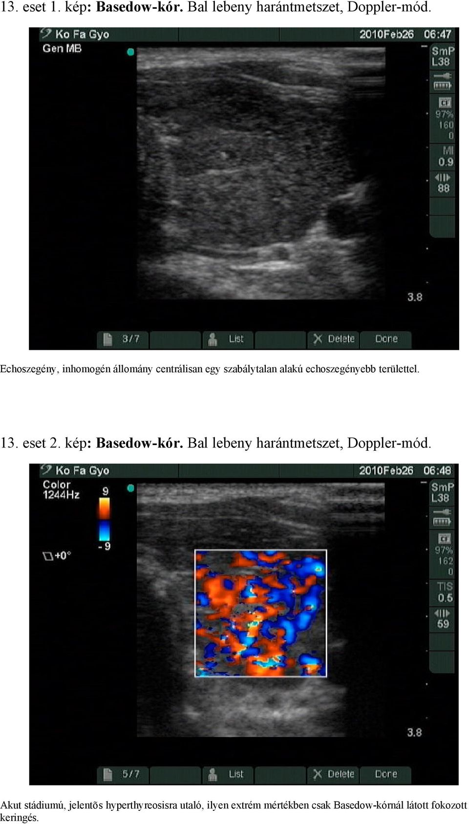 területtel. 13. eset 2. kép: Basedow-kór. Bal lebeny harántmetszet, Doppler-mód.