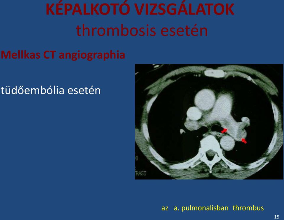 thrombosis esetén