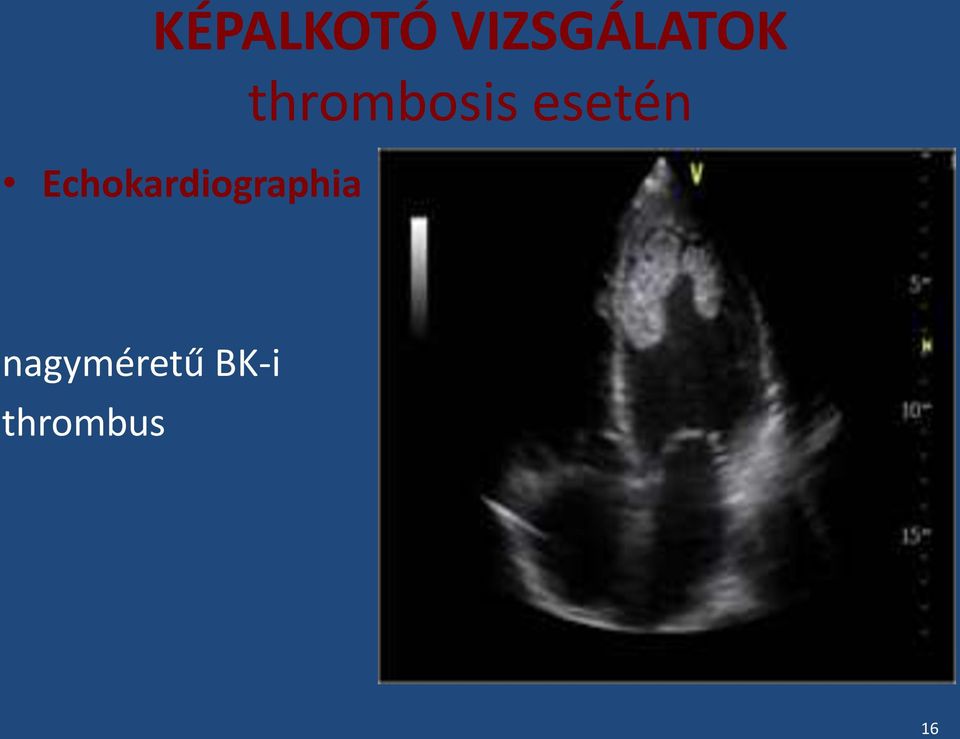 thrombosis esetén