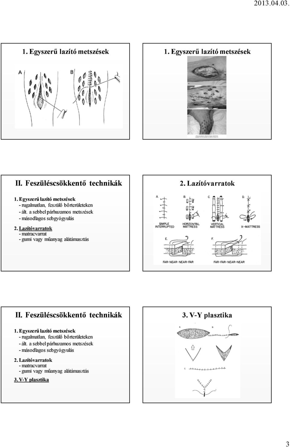 Lazítóvarratok - matracvarrat - gumi vagy műanyag alátámasztás II. Feszüléscsökkentő technikák 3. V-Y plasztika 1.